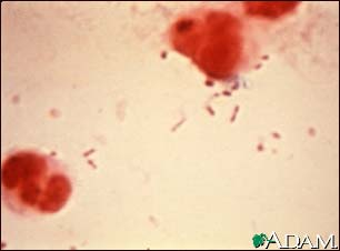 Haemophilus influenza tipo B (Hib) -bactéria capsulada -Antes da vacinação, Hib era o agente que mais comumente