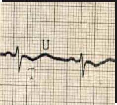 Alterações eletrocardiográficas na hipopotassemia Potássio sérico ECG Normal Onda U normal