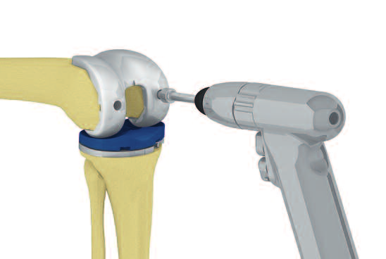 Aesculap Columbus Streamlined 12. Implantes de prova A prótese femoral de prova é introduzida com o suporte de implante do fêmur e alinhada médio lateralmente.
