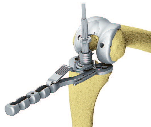 14. Preparação final da haste da tíbia A platô tibial de prova é fixado na posição desejada com os pinos curtos com cabeças com rosca e estabilizada adicionalmente com o punho.