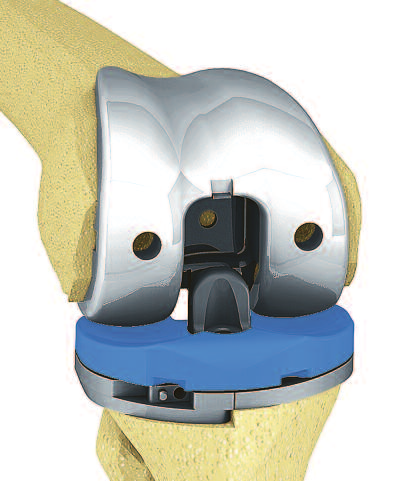 16. Prótese PS de prova Para a versão PS, a prótese femoral de prova apropriada é conectada à caixa femoral PS e implantada.