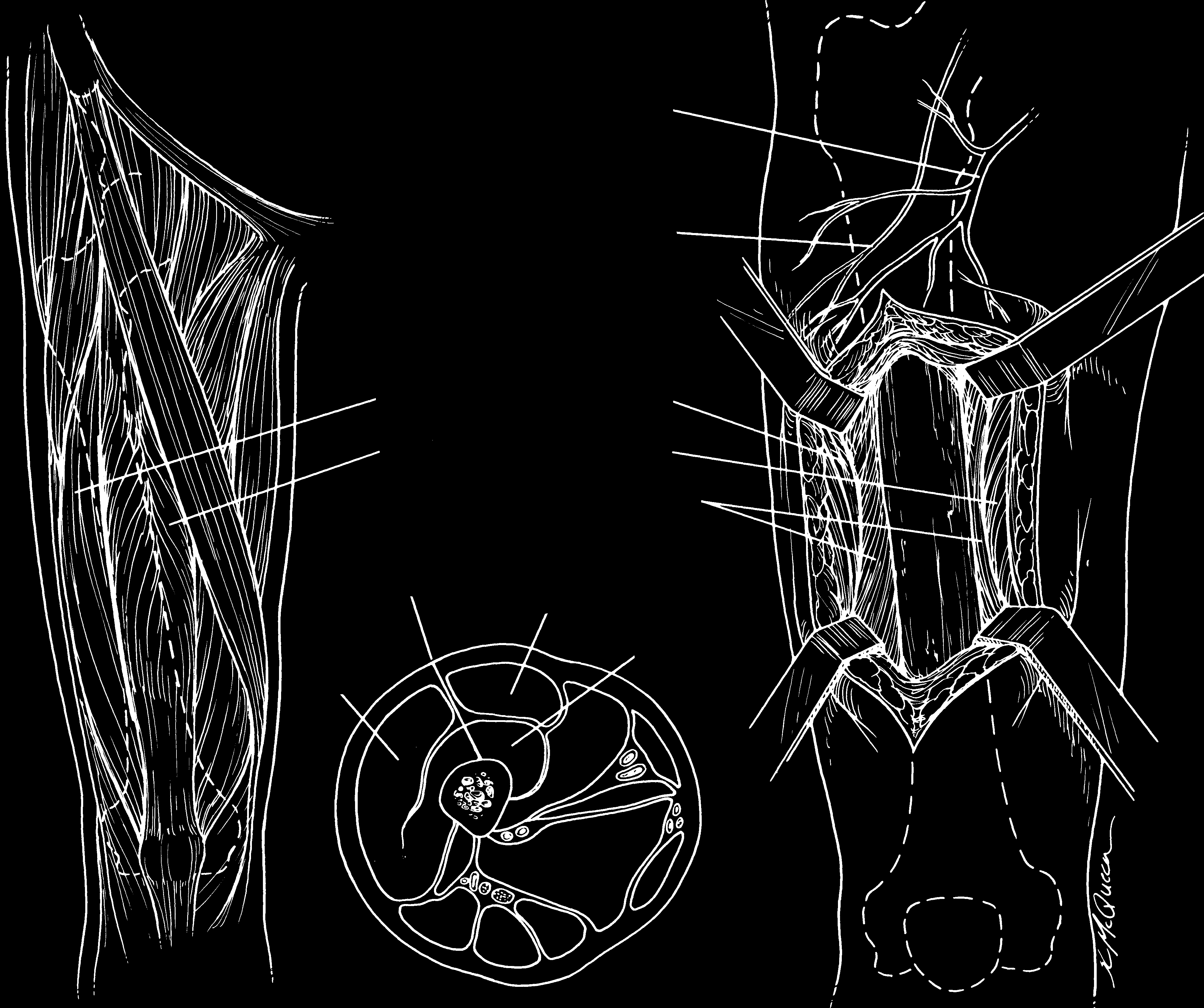 1658 Ortopedia e traumatologia: princípios e prática 1 2 3 Artéria circunflexa do fêmur Nervo para o vasto 3 4 5 vasto reto femoral vasto intermédio Reto femoral Incisão vasto vasto intermédio A B