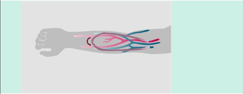 O que é um enxerto arteriovenoso? Um enxerto é um pequeno pedaço de plástico inserido entre uma artéria e uma veia em seu braço ou coxa.