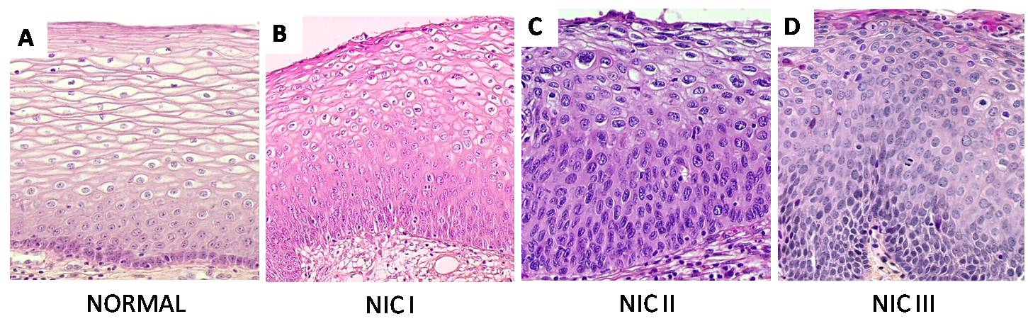 Dessa forma, quando a desordenação celular ocorre nas camadas mais basais do epitélio estratificado, verifica-se a presença de displasia leve ou neoplasia intraepitelial cervical grau I (NIC I).