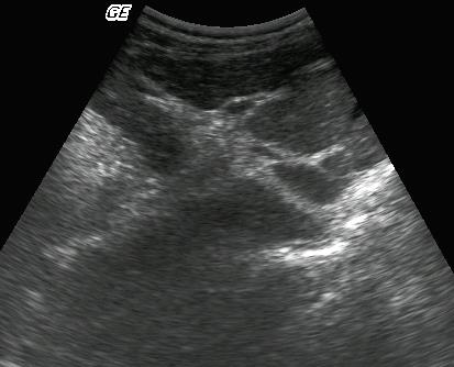 DIAGNÓSTICO DIFERENCIAL: CIRROSE X ESQUISTOSSOMOSE Leticia Martins Azeredo A cirrose e a esquistossomose hepatoesplênica são hepatopatias crônicas muito prevalentes e são as principais causas de