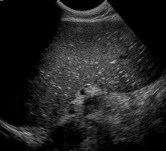 Fig. 5A Fig. 5B Fig. 5: Fibrose perivesicular leve (A) e acentuada (B) O baço encontra-se aumentado de volume, podendo acometer 90% a 100% dos pacientes na fase avançada da doença (Fig.6).