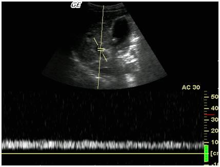 Fig. 11: Cirrose em estágio avançado: acentuada redução volumétrica do fígado e ascite. Também na cirrose, os quadros que evoluem para hipertensão portal, apresentam dilatação dos vasos portais.