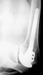 OSTEONECROSE DA CABEÇA DO ÚMERO: RESULTADOS DAS ARTROPLASTIAS a b a Fig. 3 Osteonecrose da cabeça do úmero tipo concêntrica (esq.) e excêntrica (dir.), segundo Pollock et al.