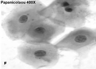 Figura 1A Histopatologia: ninhos de células epiteliais escamosas atípicas entremeadas por conjuntivo denso, exibindo aumento da relação núcleo-citoplasma, graus variados de pleomorfismo nuclear e
