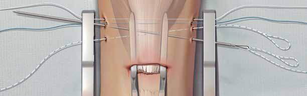 5 Passe o pino guia com a alça de nitiniol pelo primeiro orifício. O FiberWire branco n.º é puxada pela perna, deixando pontas de ambos os lados com comprimento igual.