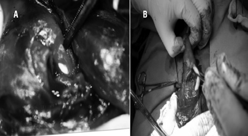 Traumatismos e urgências não traumáticas nejada com a drenagem vesical apenas, mesmo na presença de um extravasamento significativo.