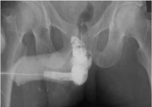 Figura 13. Uretrografia mostrando lesão completa de uretra bulbar, com ausência de contraste intravesical.