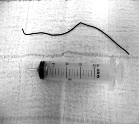 Figura 15A. Aspecto da genitália externa de uma criança vítima de queimadura elétrica após 72 horas de evolução. Observar exposição testicular com área de necrose (*).