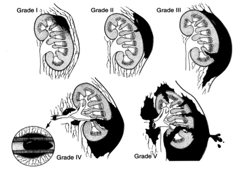 A pielografia venosa one shot foi proposta como opção para aqueles casos em que a realização de uma adequada avaliação por imagem era impossível.