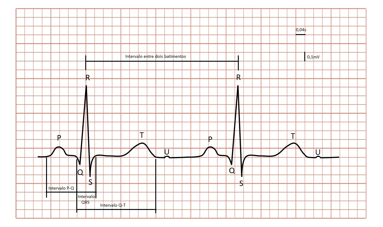 24 Figura 3: Ondas e intervalos de um sinal ECG. O complexo QRS é gerado pela despolarização dos ventrículos, antes da contração ventricular, e a onda T é devido à repolarização dos ventrículos.