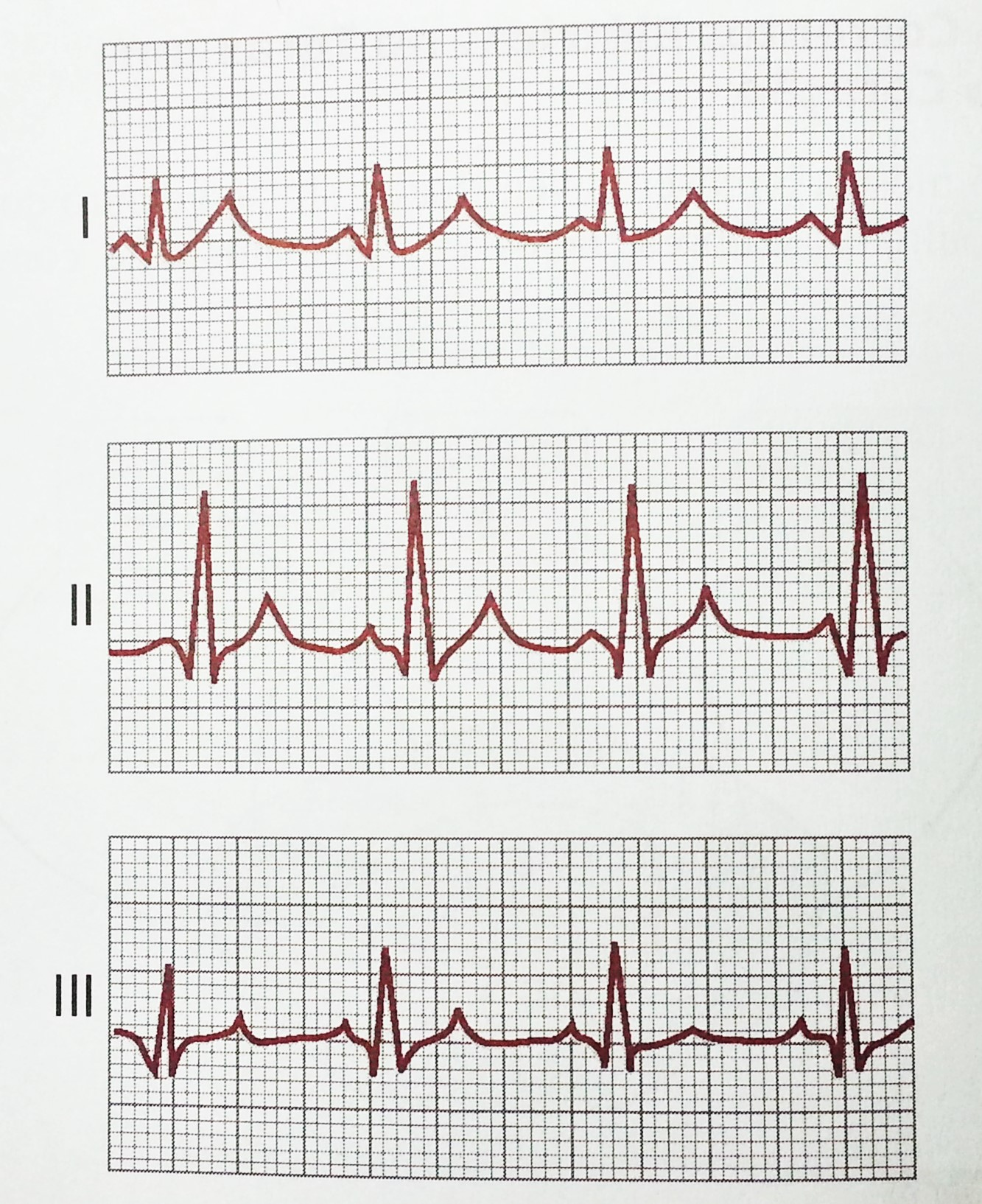28 Pelo eletrocardiograma das derivações I, II e III ilustrado pela Figura 5, observa-se que essas três derivações tem sinais eletrocardiográficos similares, sendo que as ondas P, QRS e T são