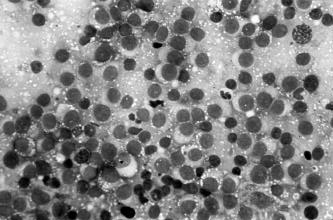 Citopatologia e histopatologia no diagnóstico de neoplasias caninas 29 3 4 5 Fig. 3. Citologia esfoliativa de Leiomioma. Van Gieson, obj. 40. Fig. 5. Citologia esfoliativa de Carcinoma de Células Escamosas.