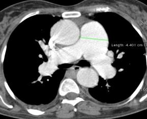 Atenuação em Mosaico Definição - PMAP > 25 mmhg repouso Cateterismo Direto - Leve 26 a 35 mmhg - Moderada 36 a 45 mmhg - Grave - > 45 mmhg Classificação Pré Capilar - Idiopática - Doença trombótica -