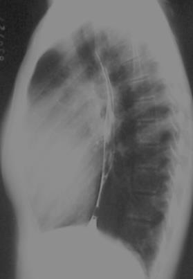 Angiotomografia HAP Primária Trombos casos graves Centrais Dilatação artérias brônquicas incomum Atenuação em Mosaico Difusa Arteriopatia Plexogênica Presente HAP Secundária Trombos e bandas