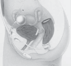 Colocação de Prótese ABS de duas incisões laterais ao ânus, seguidas de dissecção romba ao redor do canal anal para criação de túnel para implantação do cuff.