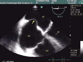 (normalmente redundante), que deve ser superior a 11 mm em relação ao plano do septo atrial em direção a qualquer um dos átrios 24.