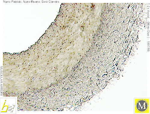 Artérias musculares Vasos de calibre até 3 mm (radial, tibial, popliteia, intercostais, etc) Íntima