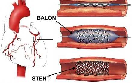 Angioplastia Técnica que utiliza um minúsculo balão inflado dentro da artéria obstruída com