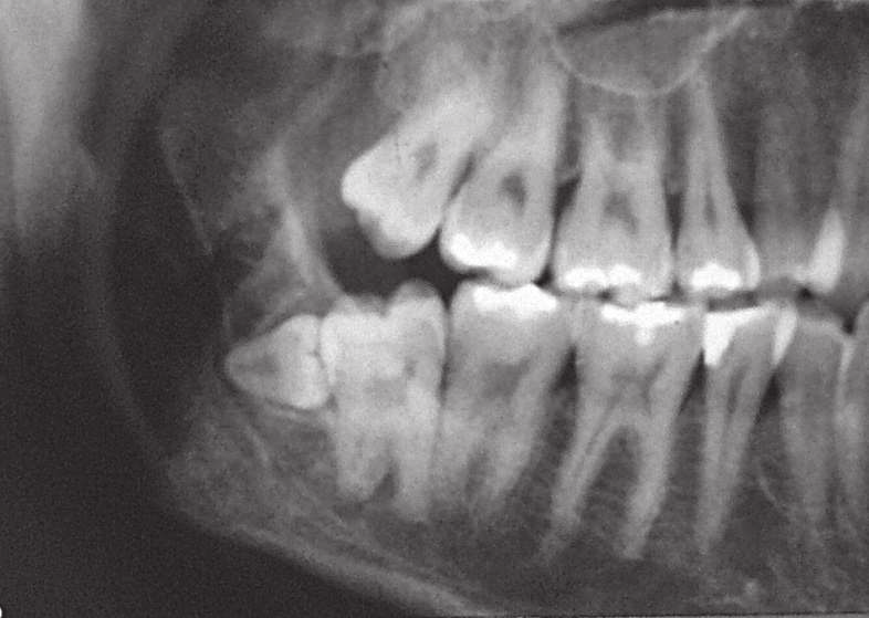 O diagnóstico dos dentes supranumerários ocorre geralmente na realização de radiografias de rotina indicadas com as mais variadas finalidades.