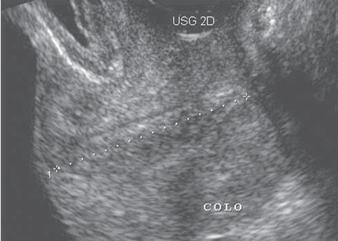 Brandão RS et al. avaliados no exame do colo uterino, o comprimento cervical é a variável mais utilizada e de maior reprodutibilidade, com reduzida variabilidade inter e intra-observador (< 10%) (4).