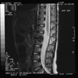 Orientando o estudo para uma possível etiologia bacilar foram realizados os seguintes exames: radiografia pulmonar normal, prova tuberculínica a 5U (29/02/00) negativa; pesquisa de Micobacterium