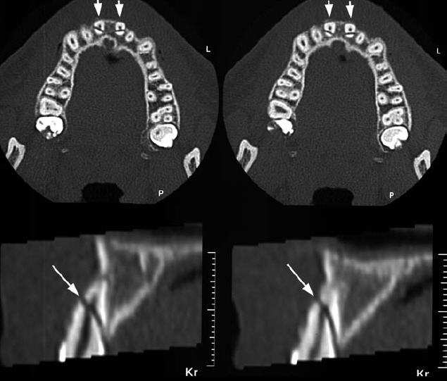 Fracturas radiculares Horizontais: exame clínico técnicas radiográficas convencionais Verticais: filme dentário (necessita que a linha de fractura