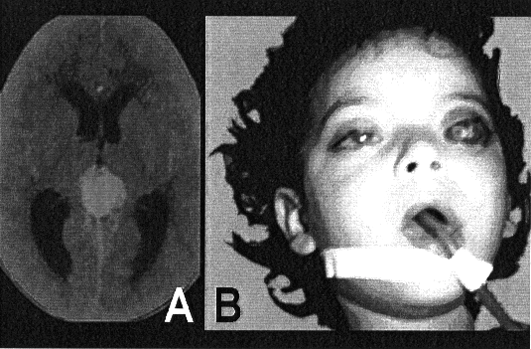 único caso trilateral (com pinealoblastoma associado) foi o mais tardio, diagnosticado aos 38 meses de idade.