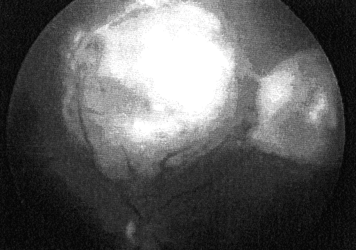 retina em funil com fibrose e calcificação após a radioterapia. O anatomo-patológico revelou que mesmo o segundo olho enucleado continha células tumorais viáveis (Fig. 3.