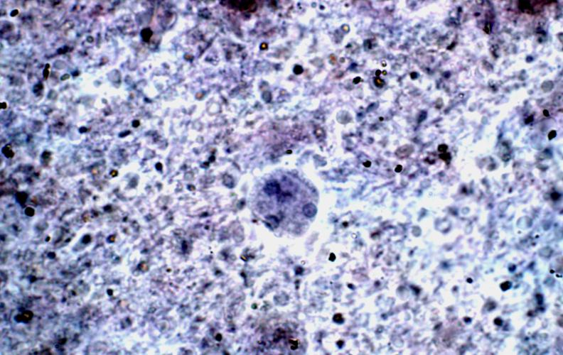 O trofozoíto mede de 20 até 40µm, apresentando núcleo com cariossoma central; o citoplasma é finamente granuloso e com vacúolos. Fotomicroscopia.