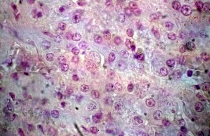 Fotomicroscopia. Corte de fígado contendo macrófagos infectados com Leishmania donovani.