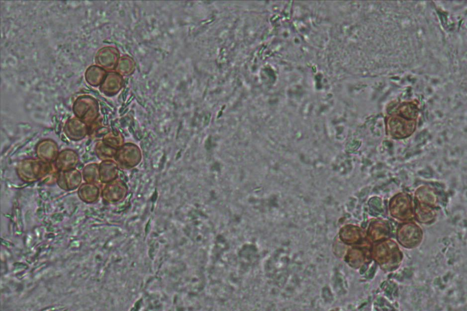 Micológico direto ( KOH 20%) Lesão verrucosa-vegetante Células globosas, de parede grossa, com ou sem septos, de cor acastanhada (corpos