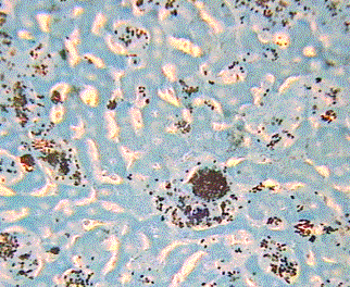 presença de macrófagos abarrotados por células