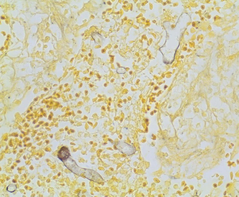 Histopatológico de Zigomicose (Rhizopus) H&E Prata Imagens cedida