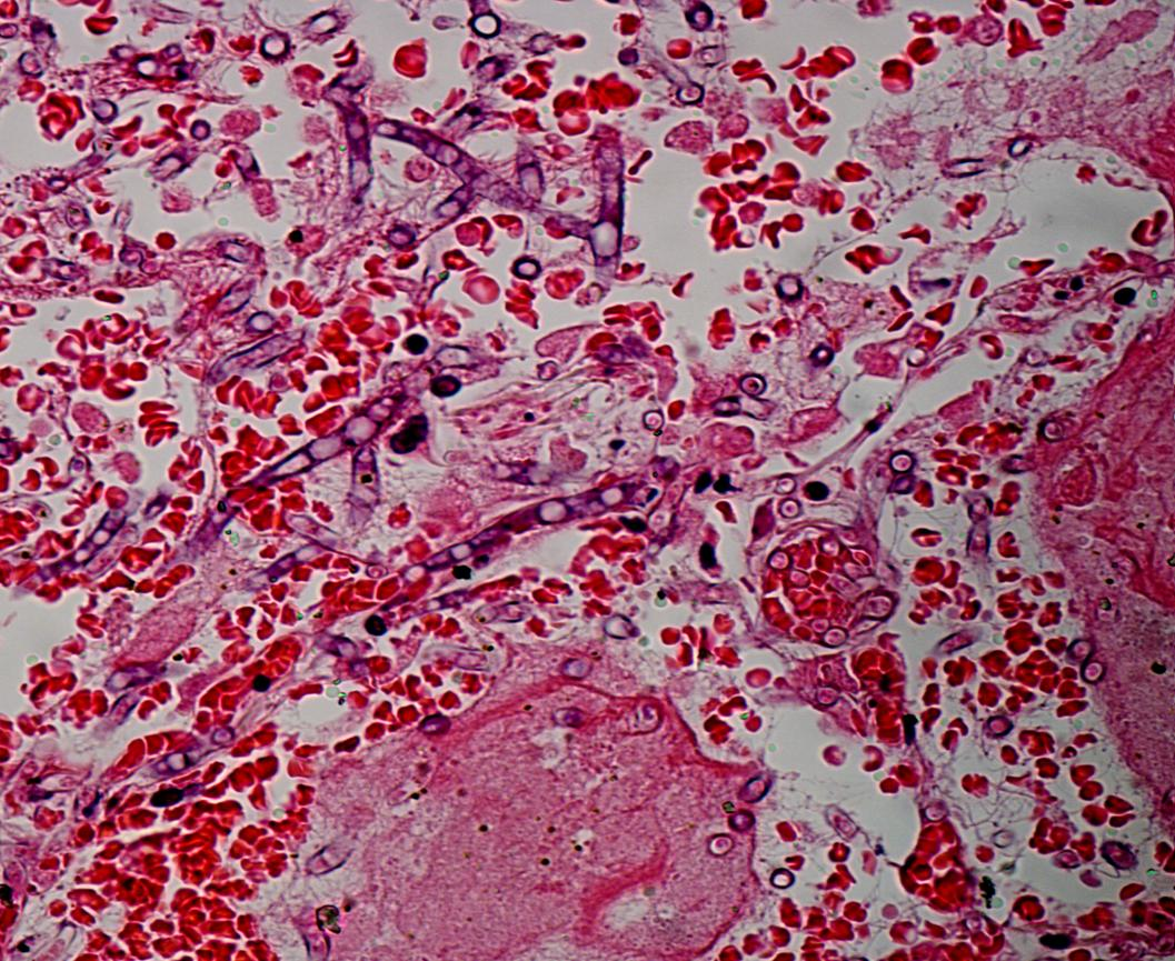 Histopatológico de Aspergillus sp H&E Prata Imagens cedida gentilmente pelo Departamento de Patologia e