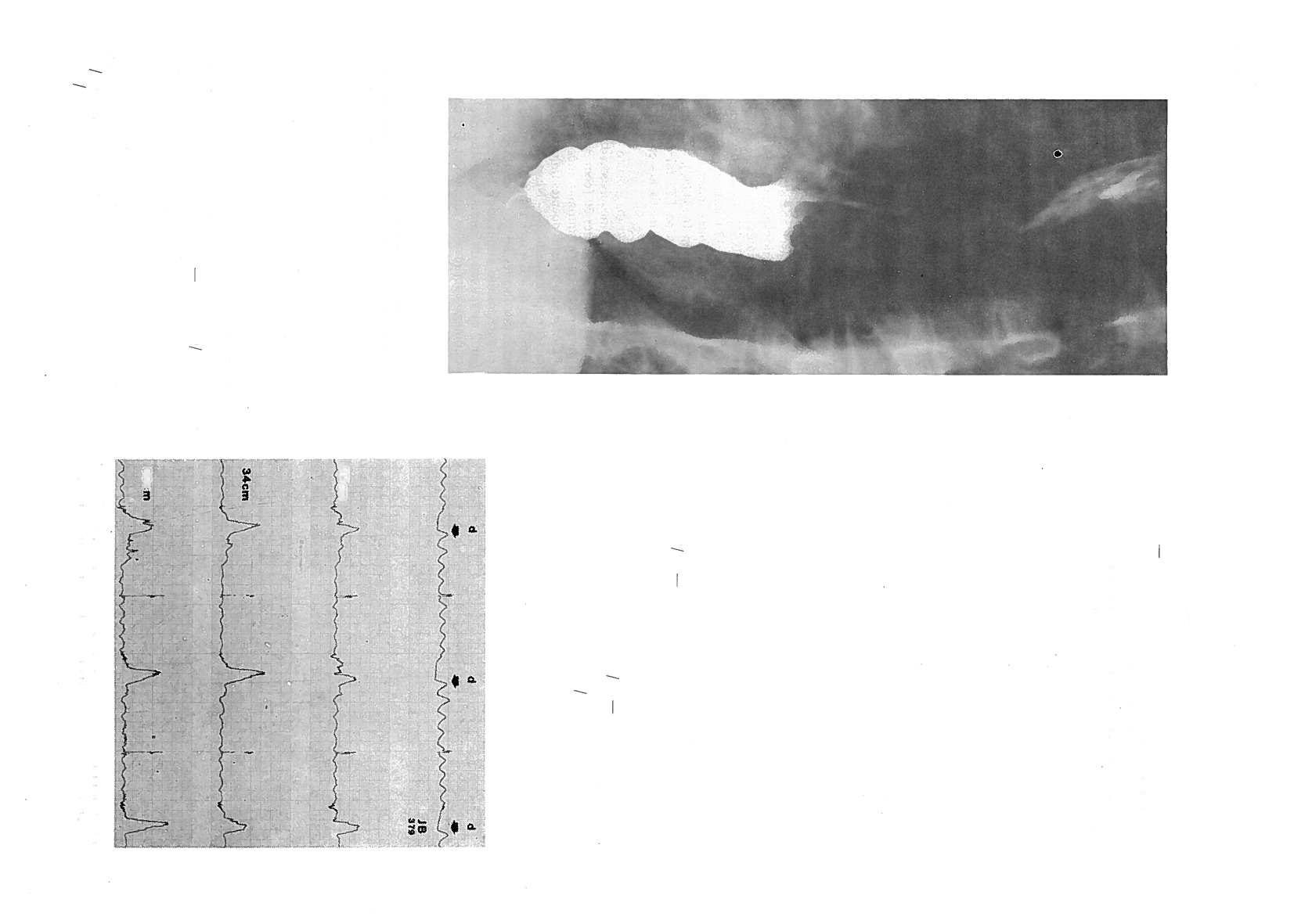 A. CARVALHINHOS ET AL QUADRO 2 Quadro sinóptico dos resultados obtidos no RX (50 doentes) e na endoscopia alta (37 doentes). Em 40% o RX era inequívoco de acalásia.