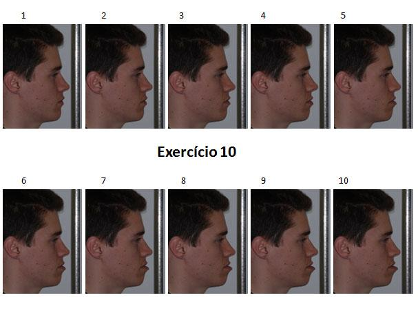 3.2. Modificação fotográfica do lábio inferior Uma porção de 10 mm da régua de calibração foi copiada, rodada 90º, e transferida à zona anterior ao lábio inferior, utilizando o programa Adobe