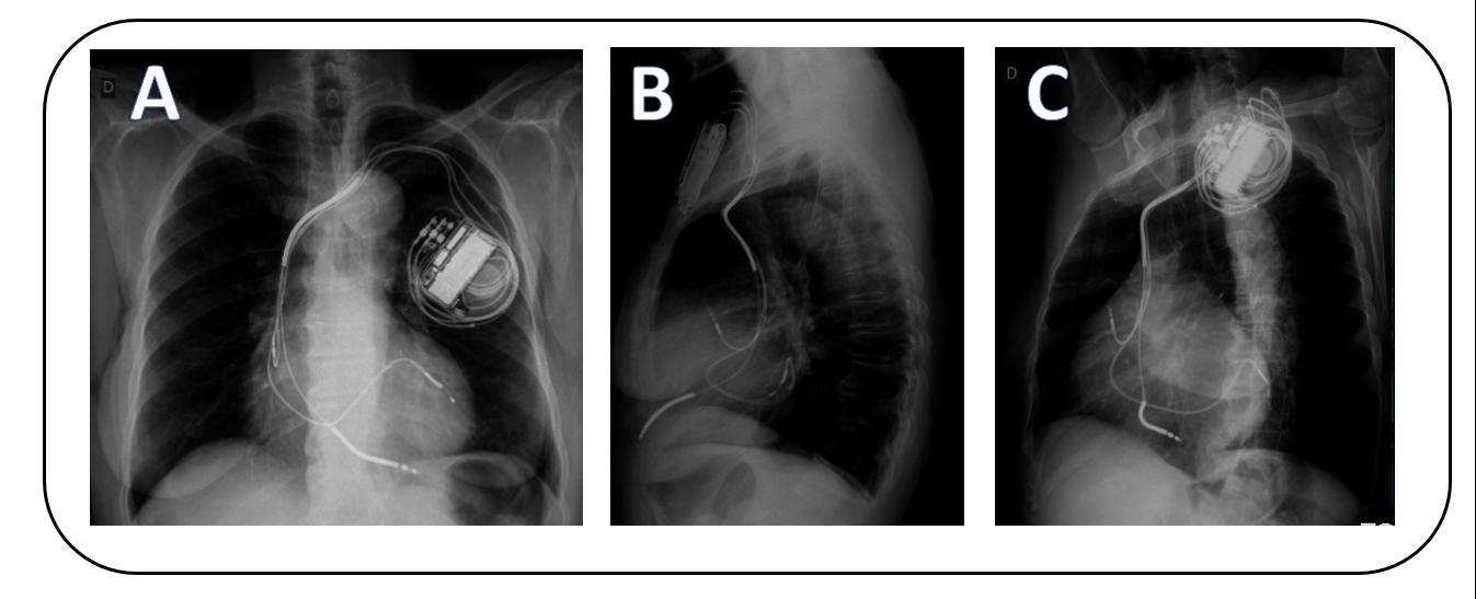 29 Figura 5 - Radiografias de tórax para avaliação da posição dos eletrodos nas incidências póstero-anterior (A), perfil (B) e