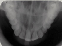 RESULTADOS O presente estudo radiográfico tem como base 36 dentes caninos superiores impactados de 31 pacientes selecionados clinicamente, em cujo exame clínico detectou-se a presença do dente canino