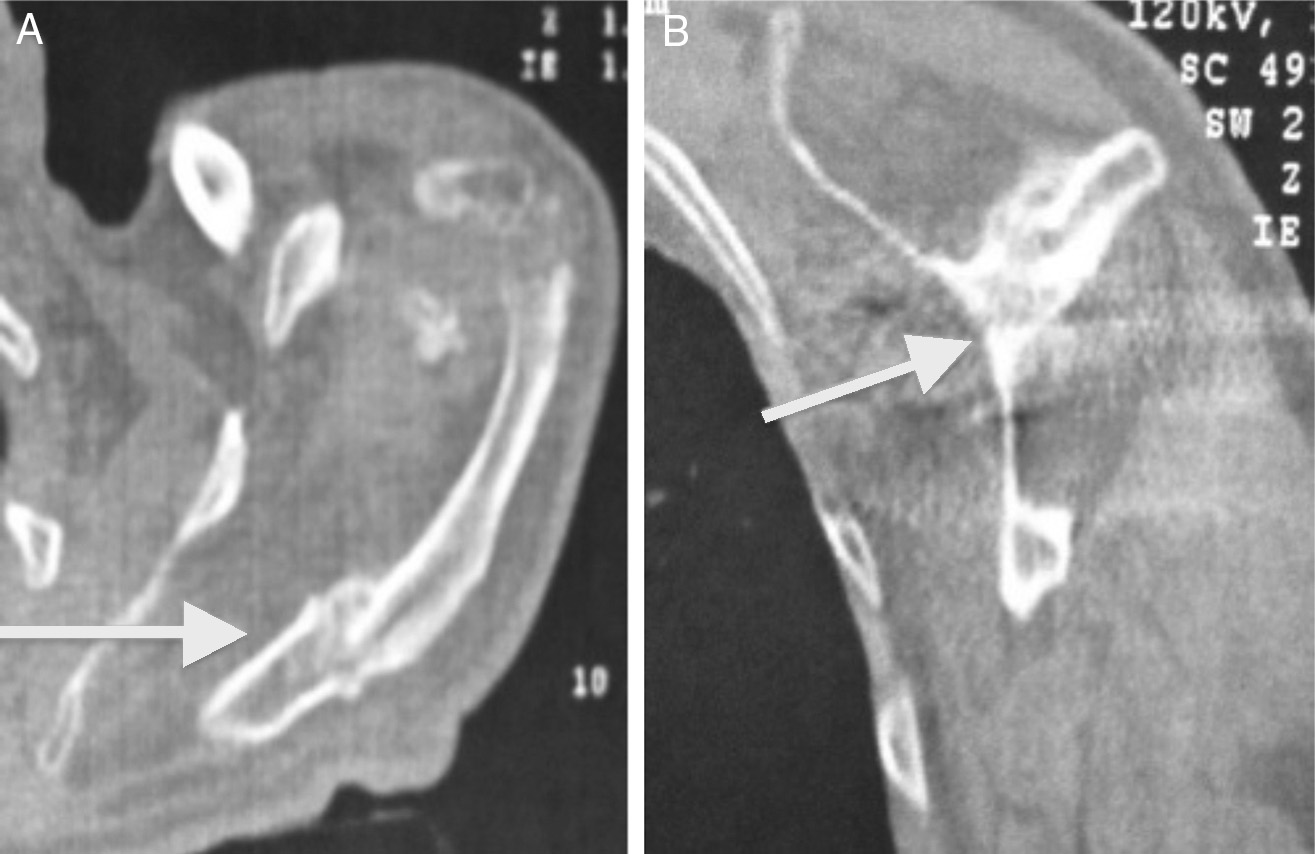 282 rev bras ortop. 2014;49(3):279 285 Figura 2 A e B Fratura por estresse do acrômio. ação isolada do deltoide.