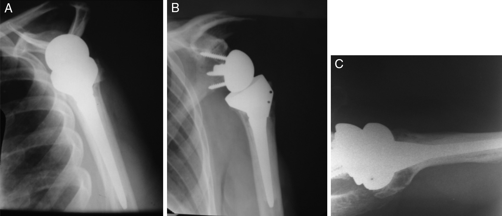 rev bras ortop. 2014;49(3):279 285 283 Figura 4 A-C Exames de imagem pós-operatórios.