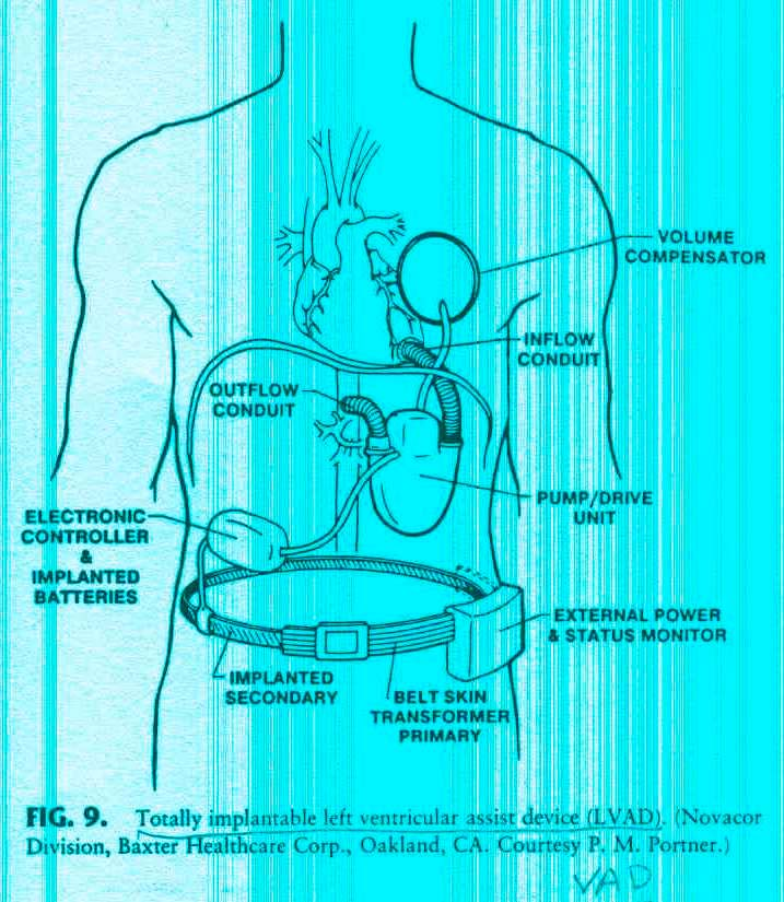 Componentes de assistência ventricular e coração artificial usados quando o coração falha de forma irreversível e não é possível transplante (não há corações disponíveis) implante de
