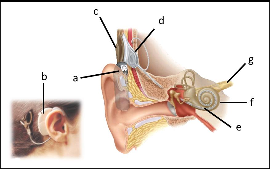 Introdução 2 Os indivíduos com perda auditiva neurossensorial de grau severo a profundo bilateral, que não possuem acesso aos sons da fala com as próteses auditivas convencionais, são possíveis