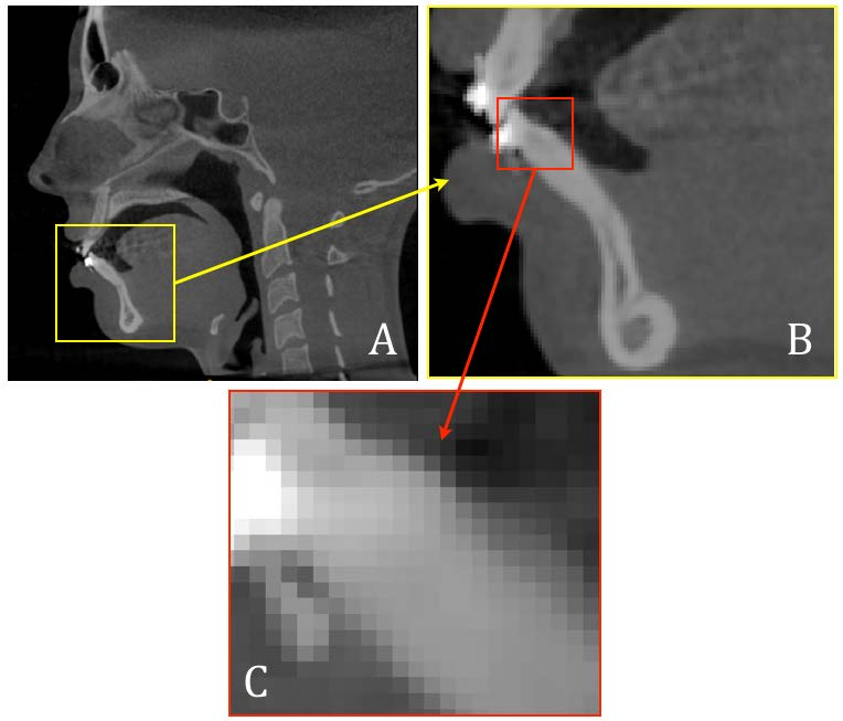 Material e Método 58 Figura 2 - A. e B. Imagem da tomografia em escala de cinza após transformação dos voxels para 0,5 x 0,5 x 0,5mm C.