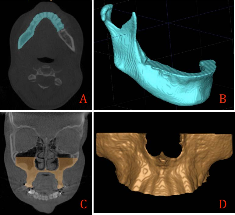 Material e Método 63 Figura 6 - A. Vista axial do recorte manual da mandíbula feito na distal do 2 segundo pré- molar e mesial do primeiro molar B.