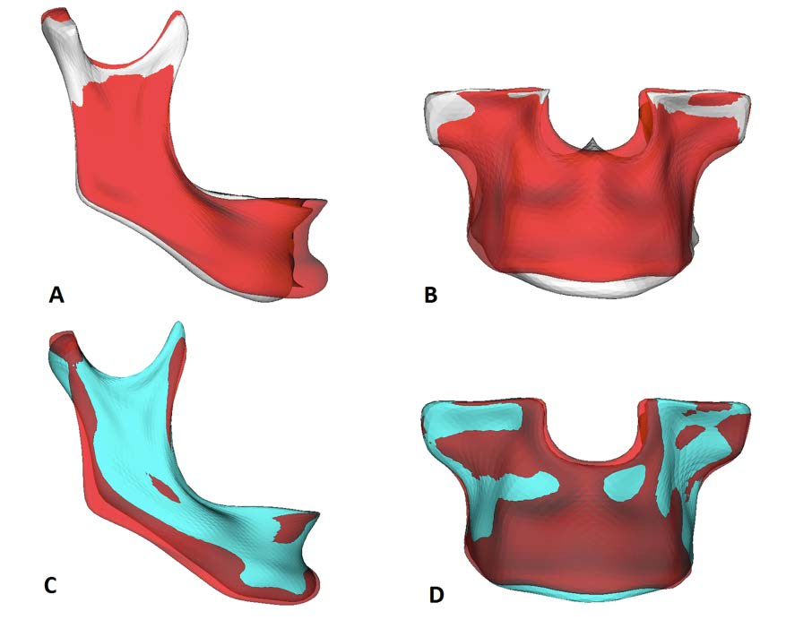 Material e Método 65 Figura 7 - A e B. Mapa de semi- transparências da mandíbula e maxila representando os deslocamentos cirúrgicos ocorridos - T2 (vermelho) - T1 (branco).